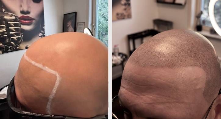SMP Scalp Micro Pigmentation