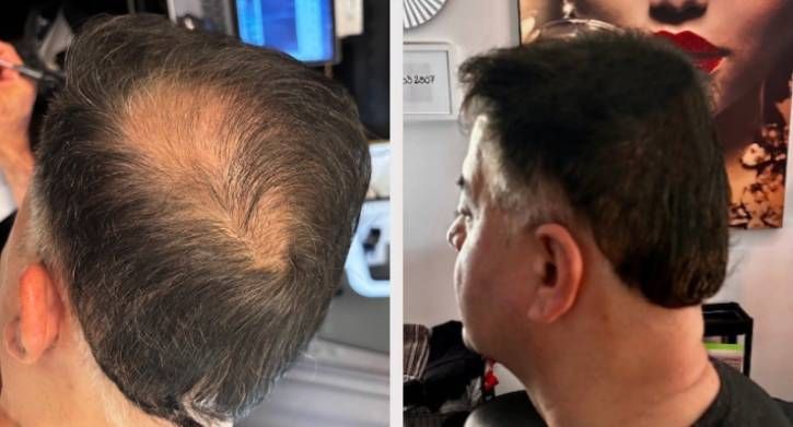 SMP Scalp Micro Pigmentation