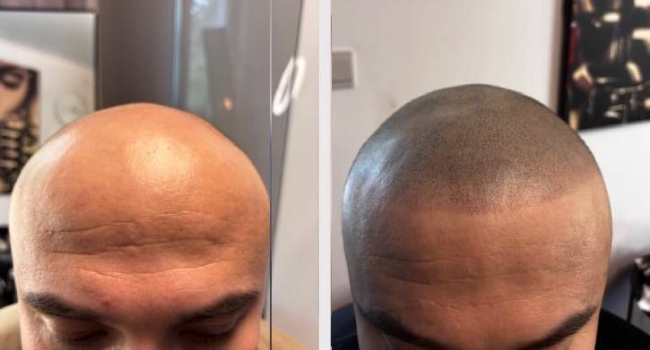 SMP Scalp Micro Pigmentation