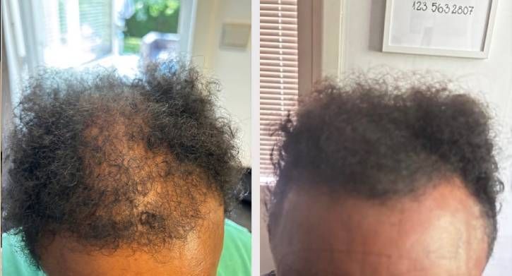 SMP Scalp Micro Pigmentation