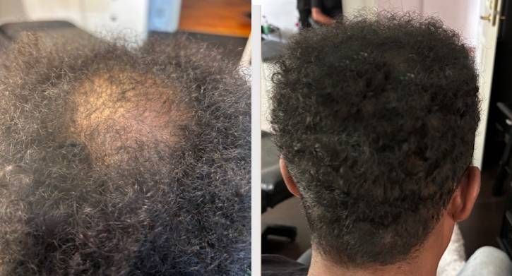 SMP Scalp Micro Pigmentation