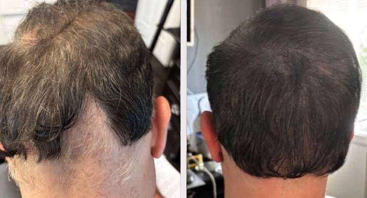 SMP Scalp Micro Pigmentation