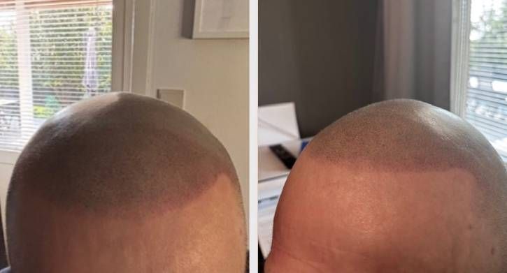 SMP Scalp Micro Pigmentation