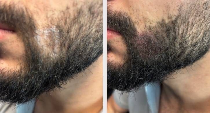 SMP Scalp Micro Pigmentation