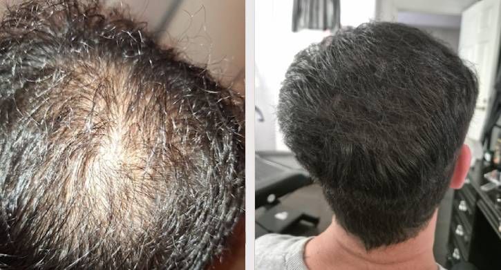 SMP Scalp Micro Pigmentation
