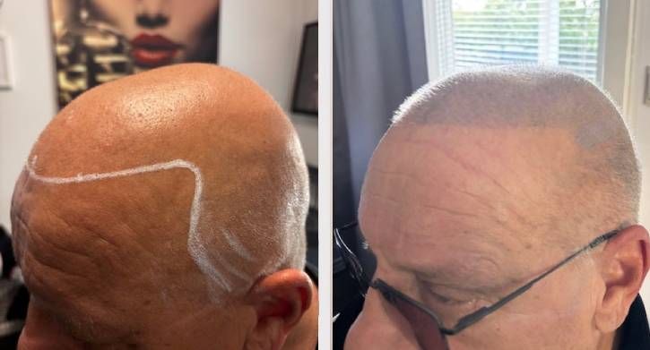 SMP Scalp Micro Pigmentation