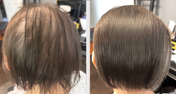 SMP Scalp Micro Pigmentation