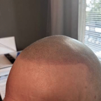 SMP Scalp Micro Pigmentation