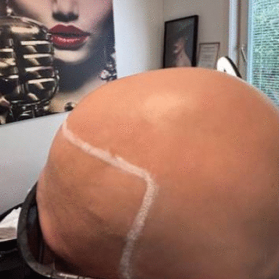 SMP Scalp Micro Pigmentation